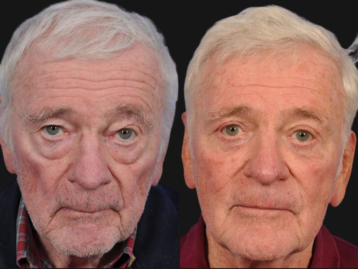 Blepharoplasty Before & After Gallery - Patient 414777 - Image 1