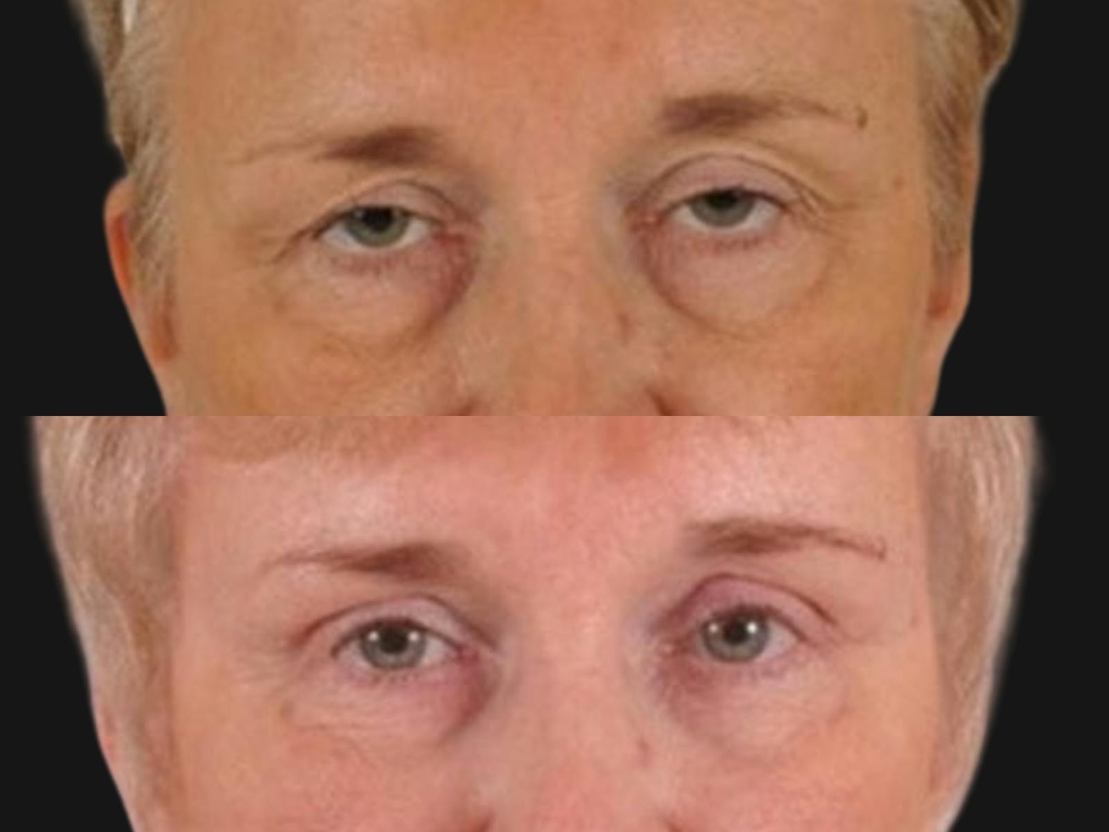 Blepharoplasty Before & After Gallery - Patient 126331 - Image 1