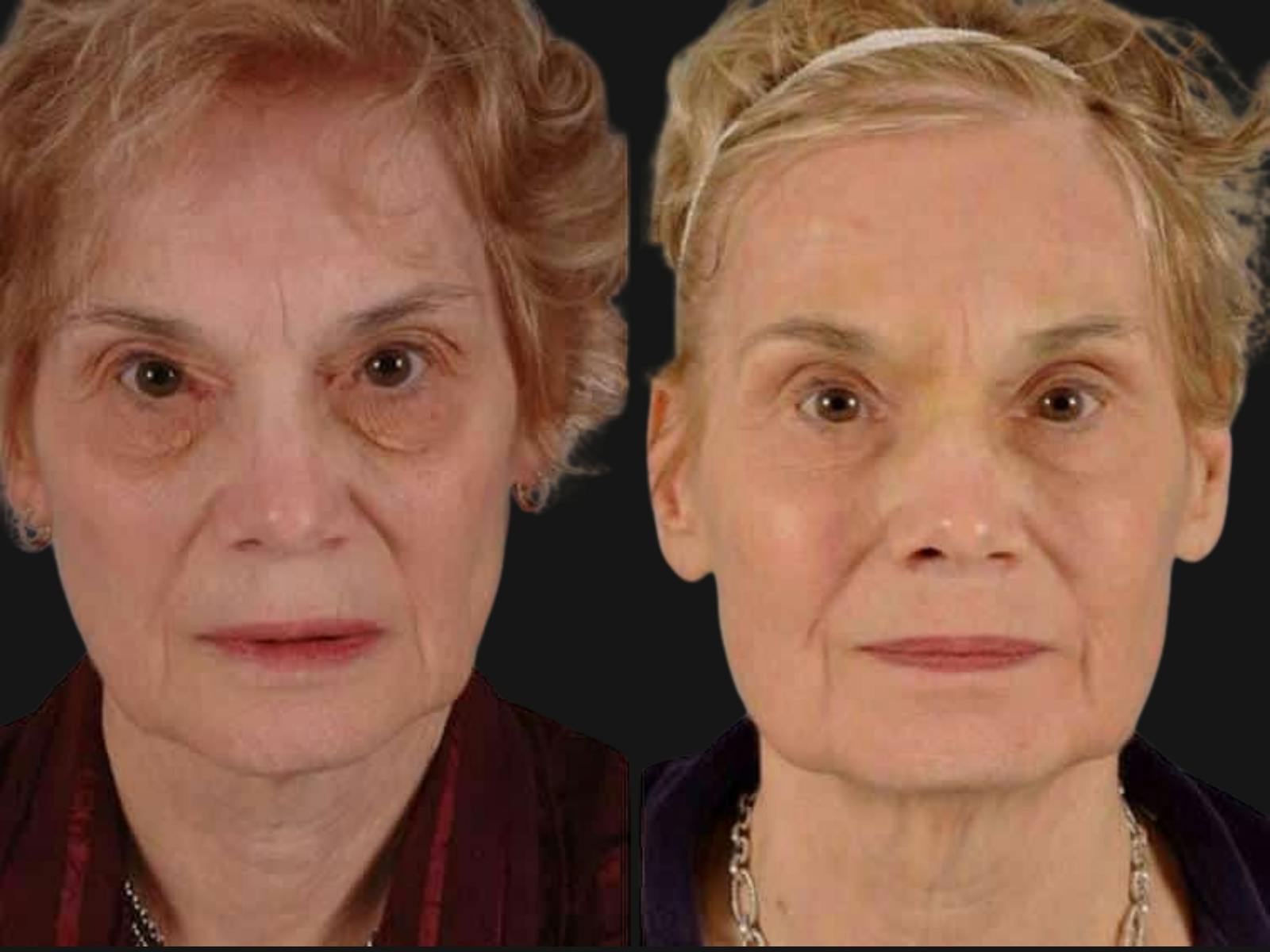 Blepharoplasty Before & After Gallery - Patient 411121 - Image 1