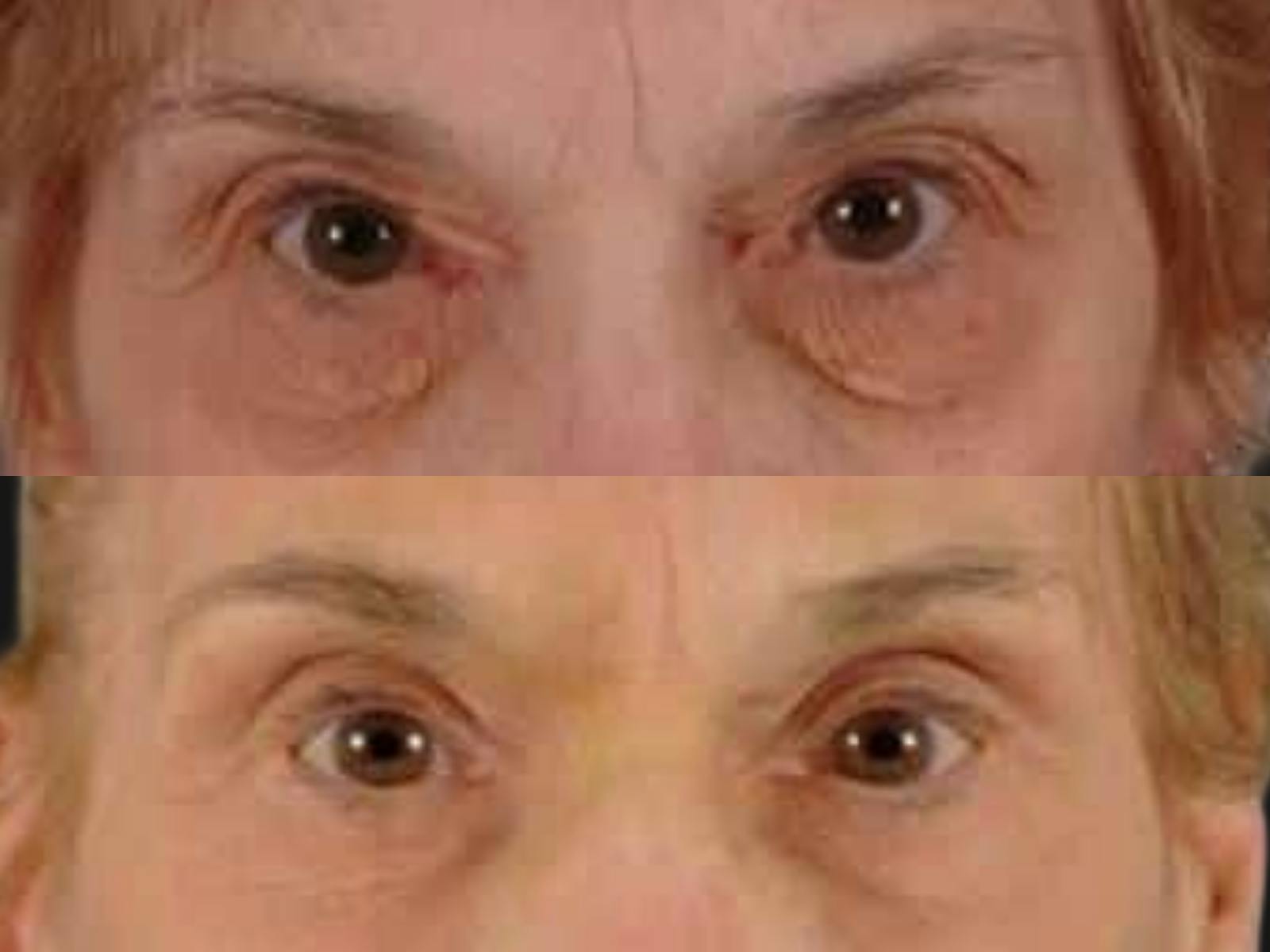 Blepharoplasty Before & After Gallery - Patient 411121 - Image 2