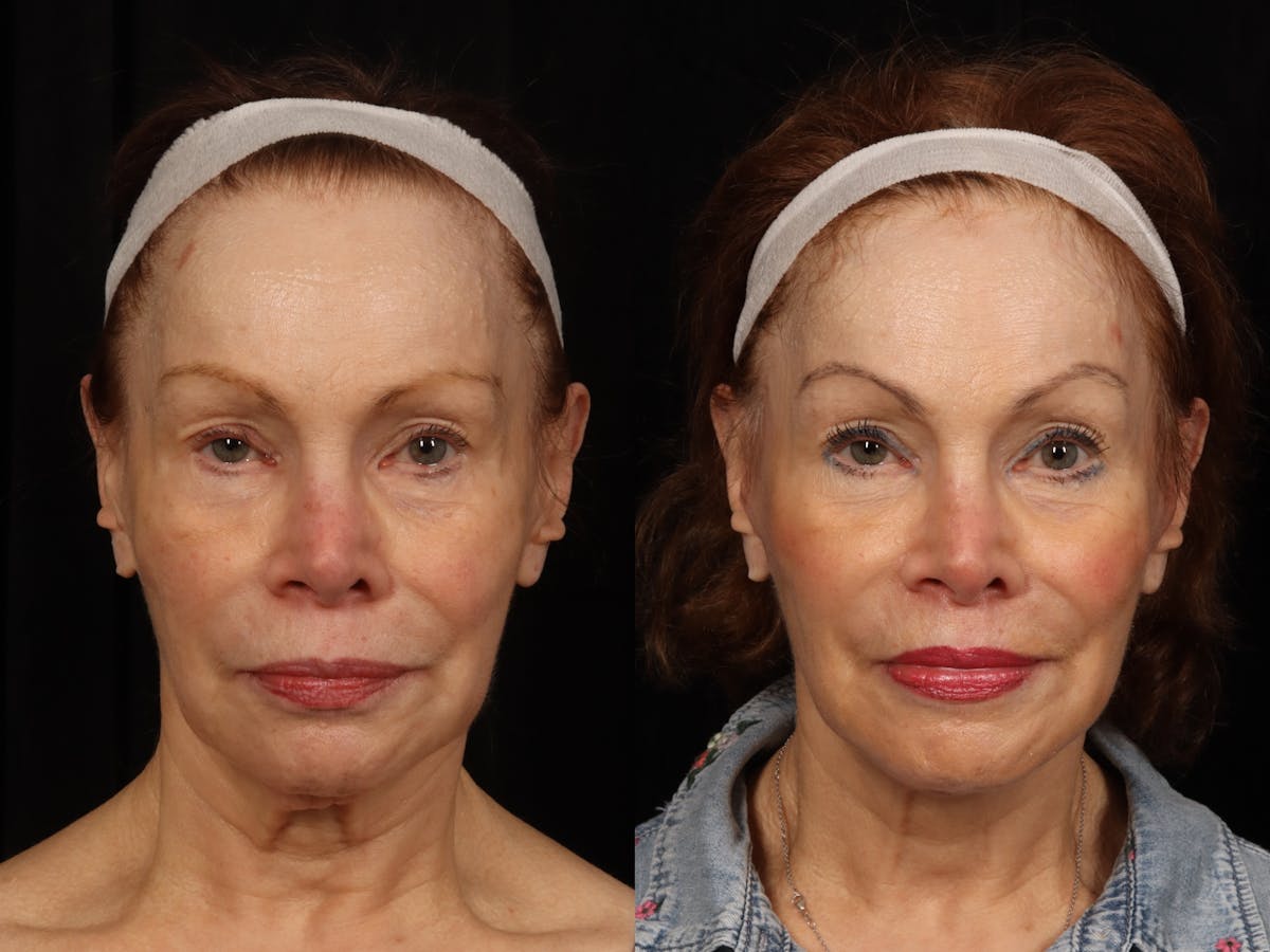 Facelift Before & After Gallery - Patient 160196 - Image 1