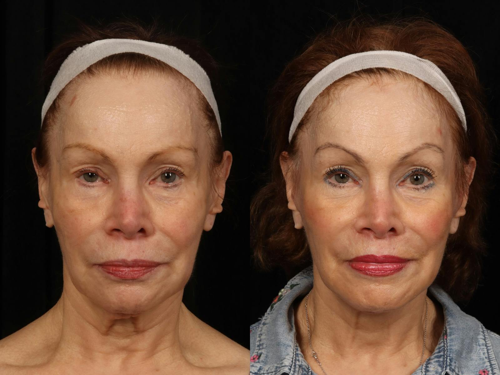 Facelift Before & After Gallery - Patient 160196 - Image 1