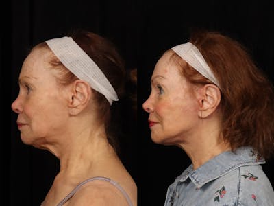 Facelift Before & After Gallery - Patient 160196 - Image 2