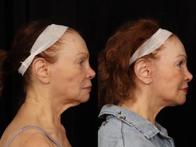 Facelift Before & After Gallery - Patient 160196 - Image 3