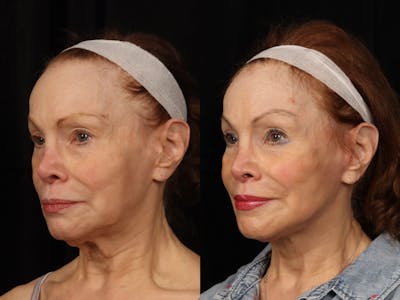 Facelift Before & After Gallery - Patient 160196 - Image 4