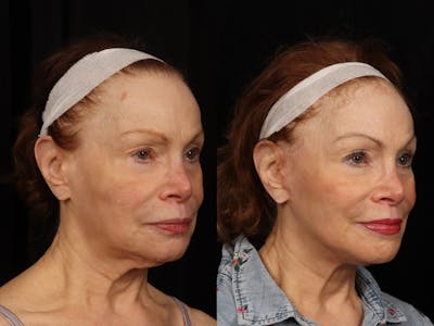 Facelift Before & After Gallery - Patient 160196 - Image 5