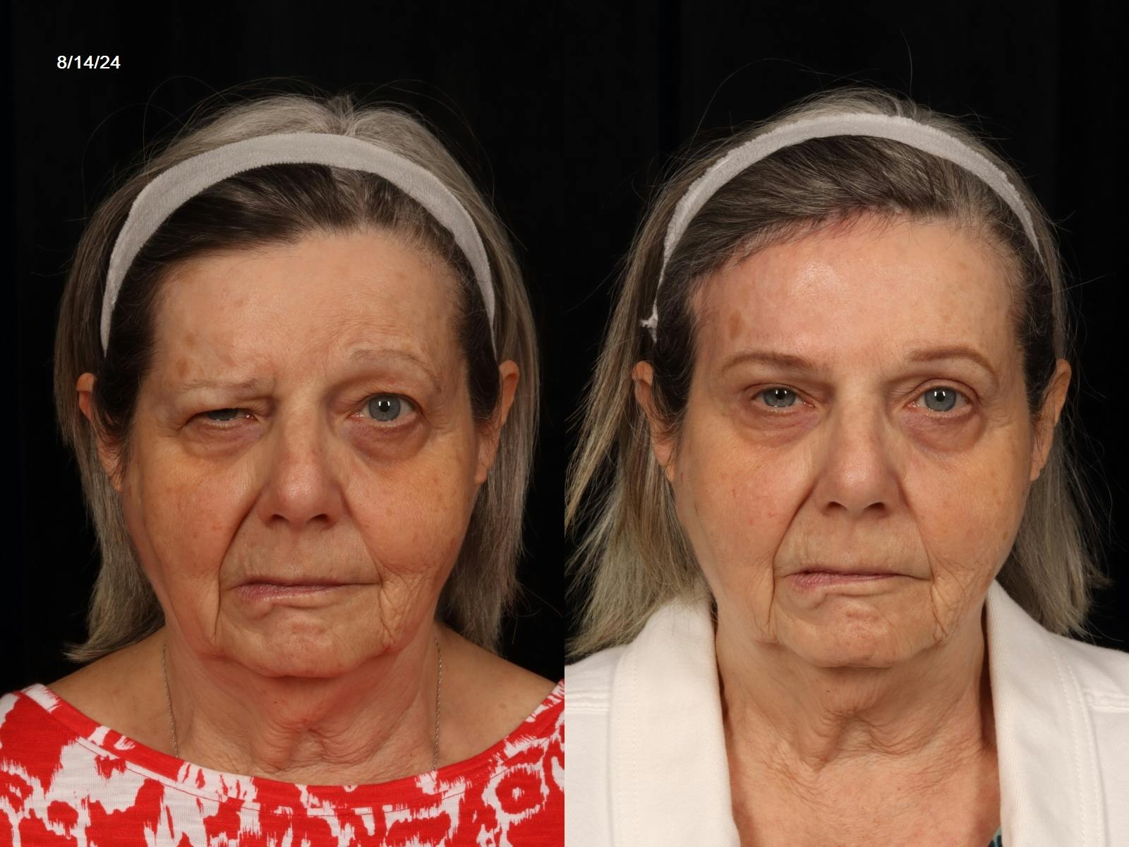 Blepharoplasty Before & After Gallery - Patient 221721 - Image 1