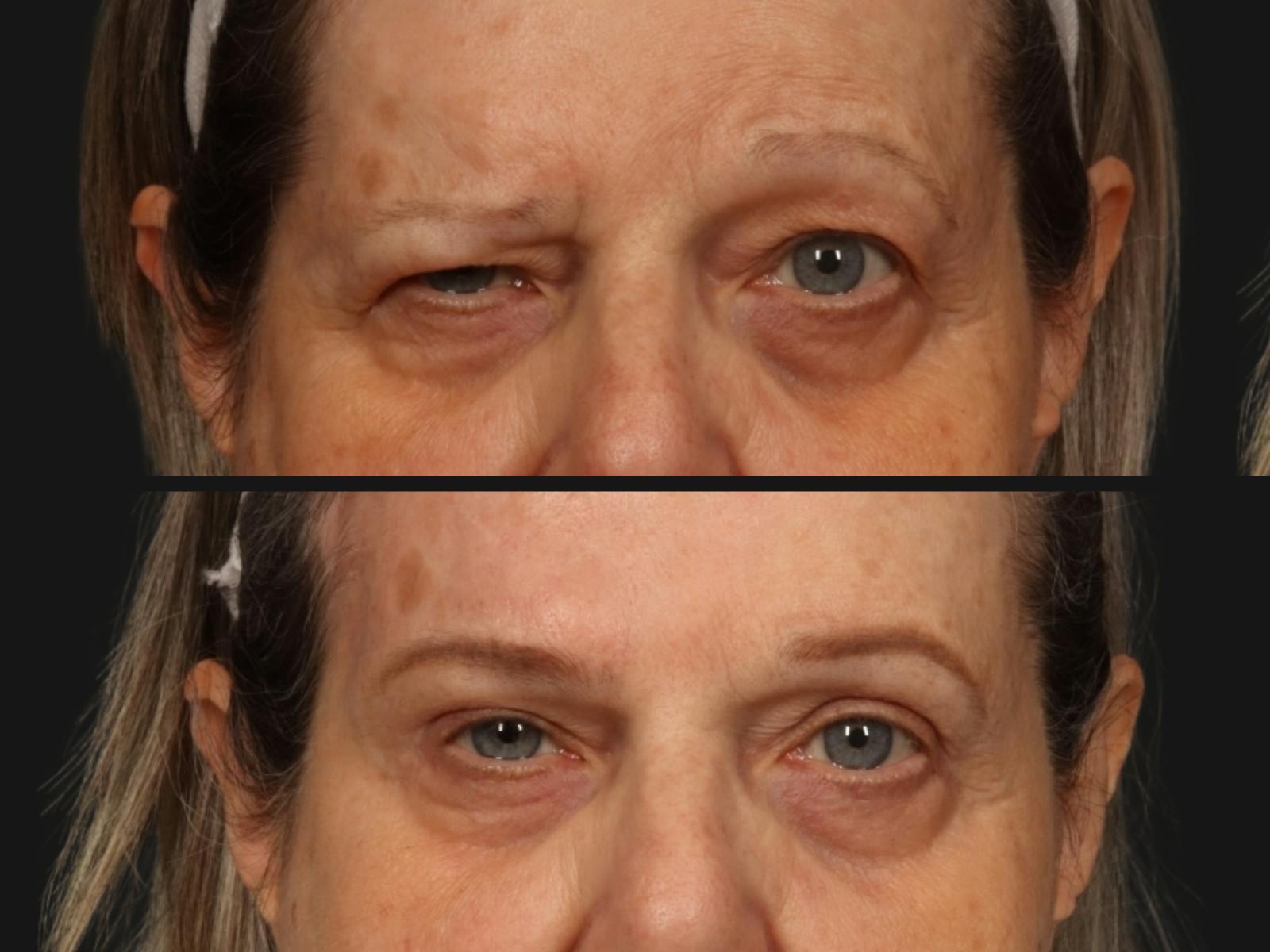 Blepharoplasty Before & After Gallery - Patient 221721 - Image 2