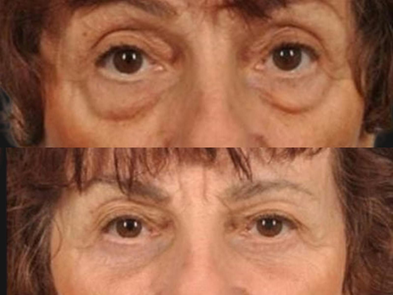 Blepharoplasty Before & After Gallery - Patient 135358 - Image 2