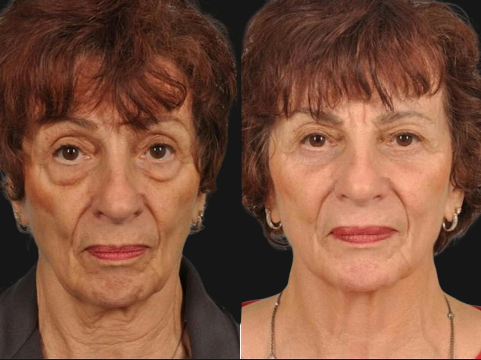 Blepharoplasty Before & After Gallery - Patient 135358 - Image 1