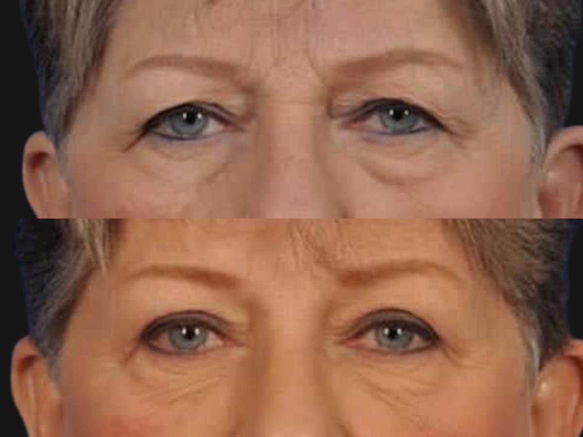 Blepharoplasty Before & After Gallery - Patient 369942 - Image 2