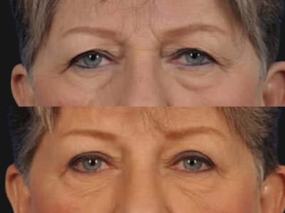 Blepharoplasty Before & After Gallery - Patient 369942 - Image 2