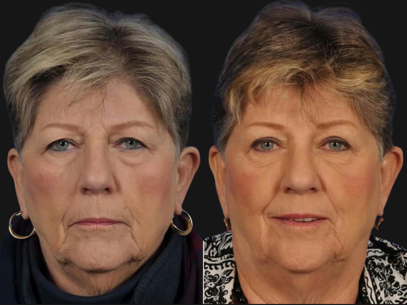 Blepharoplasty Before & After Gallery - Patient 369942 - Image 1