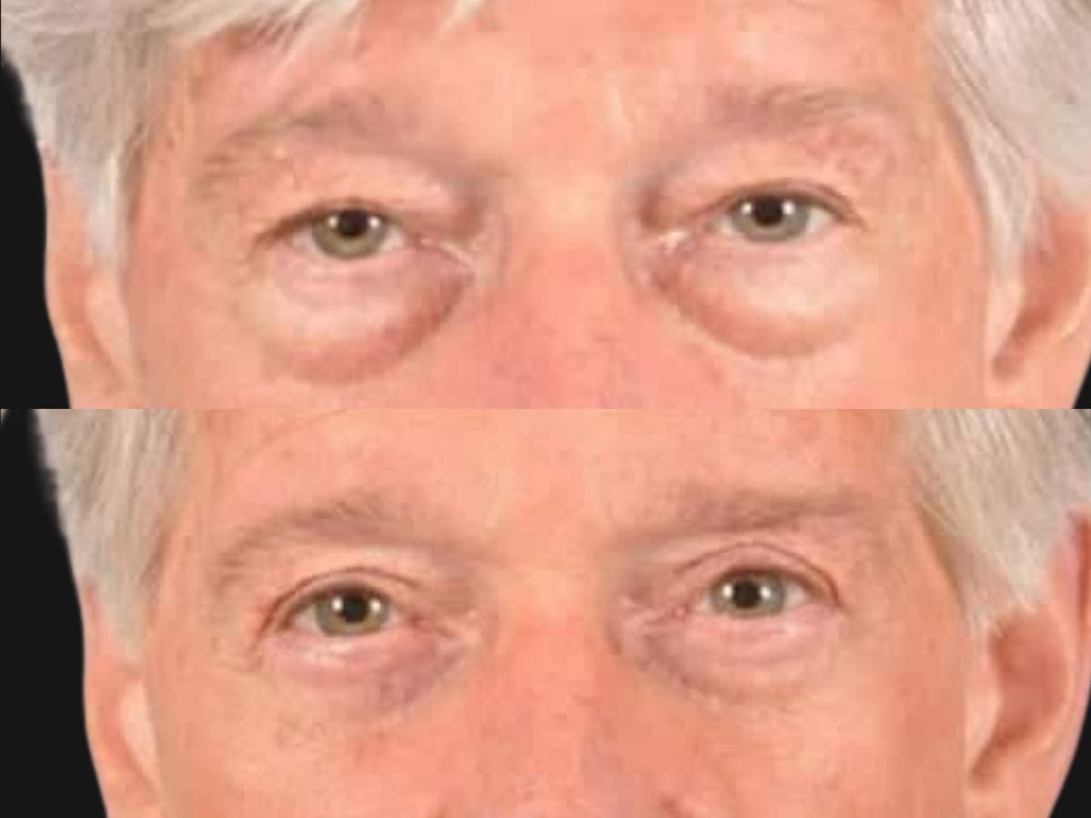 Blepharoplasty Before & After Gallery - Patient 226514 - Image 2