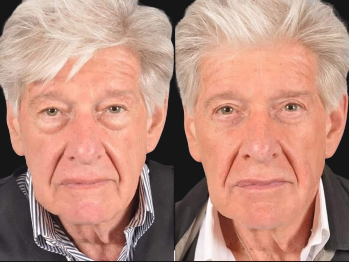 Blepharoplasty Before & After Gallery - Patient 226514 - Image 1
