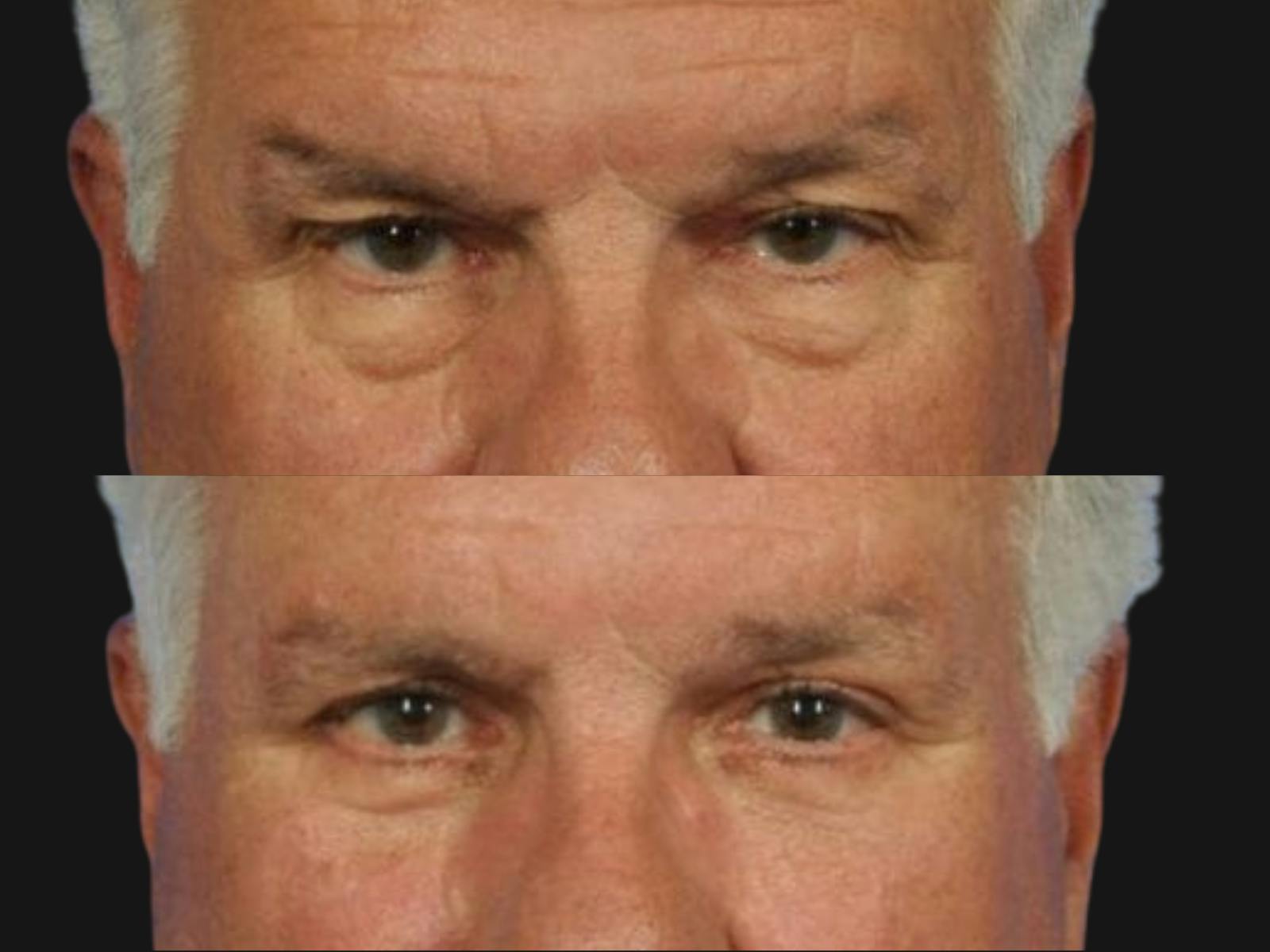 Blepharoplasty Before & After Gallery - Patient 171080 - Image 2
