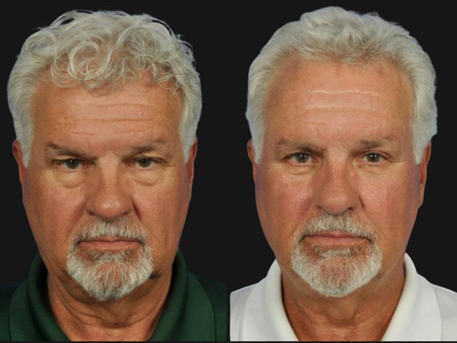 Blepharoplasty Before & After Gallery - Patient 171080 - Image 1