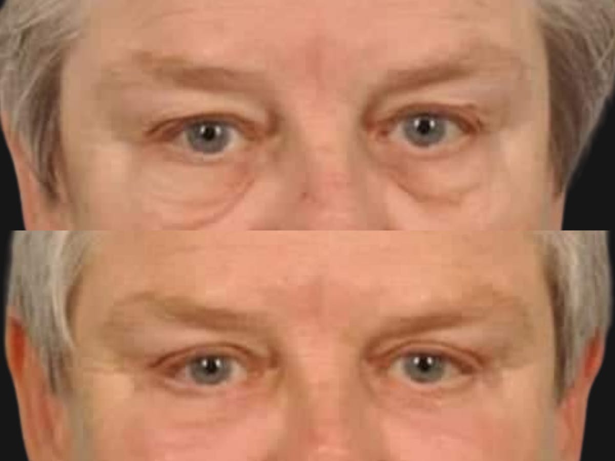 Blepharoplasty Before & After Gallery - Patient 246192 - Image 2