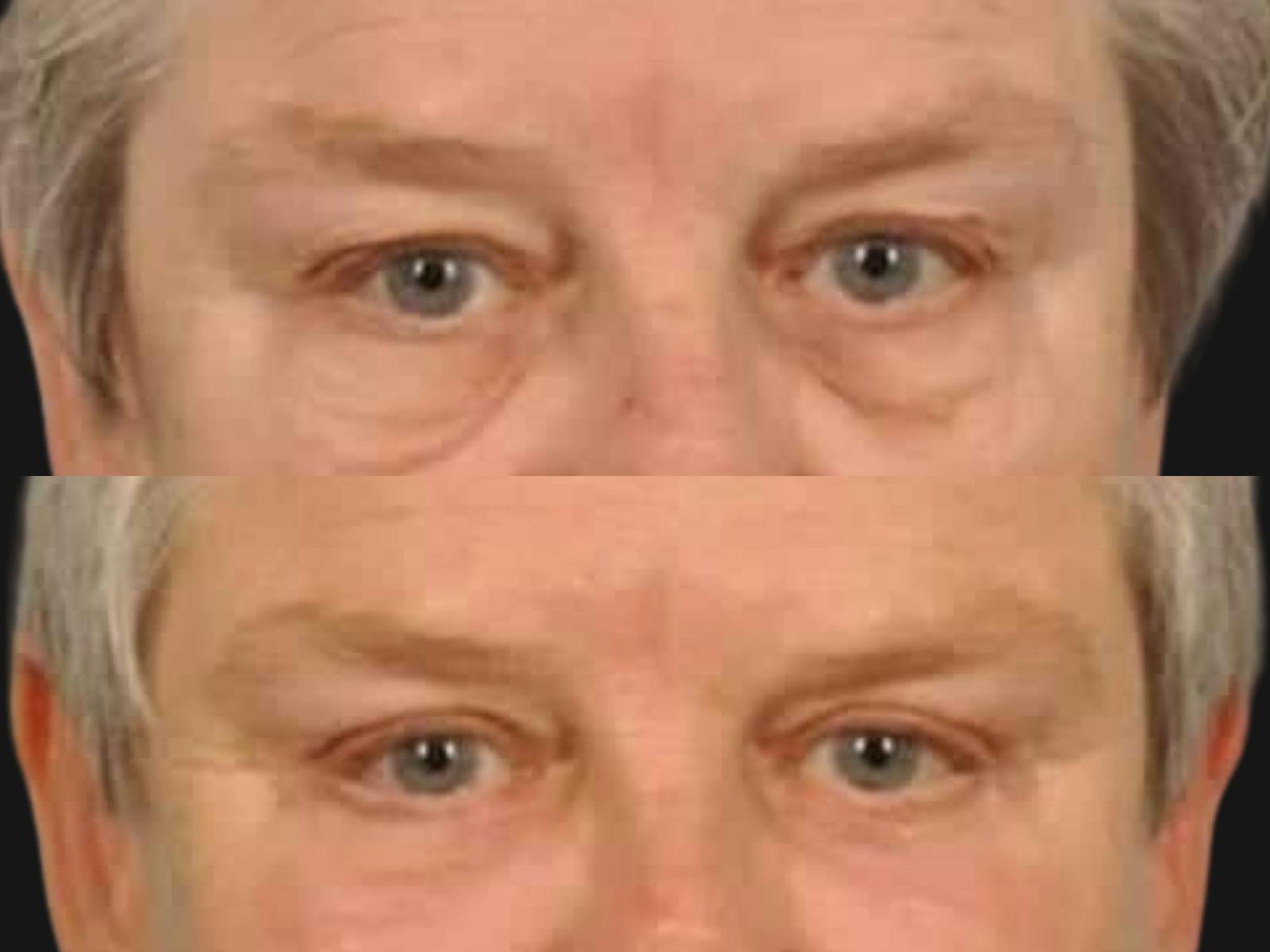 Blepharoplasty Before & After Gallery - Patient 246192 - Image 2