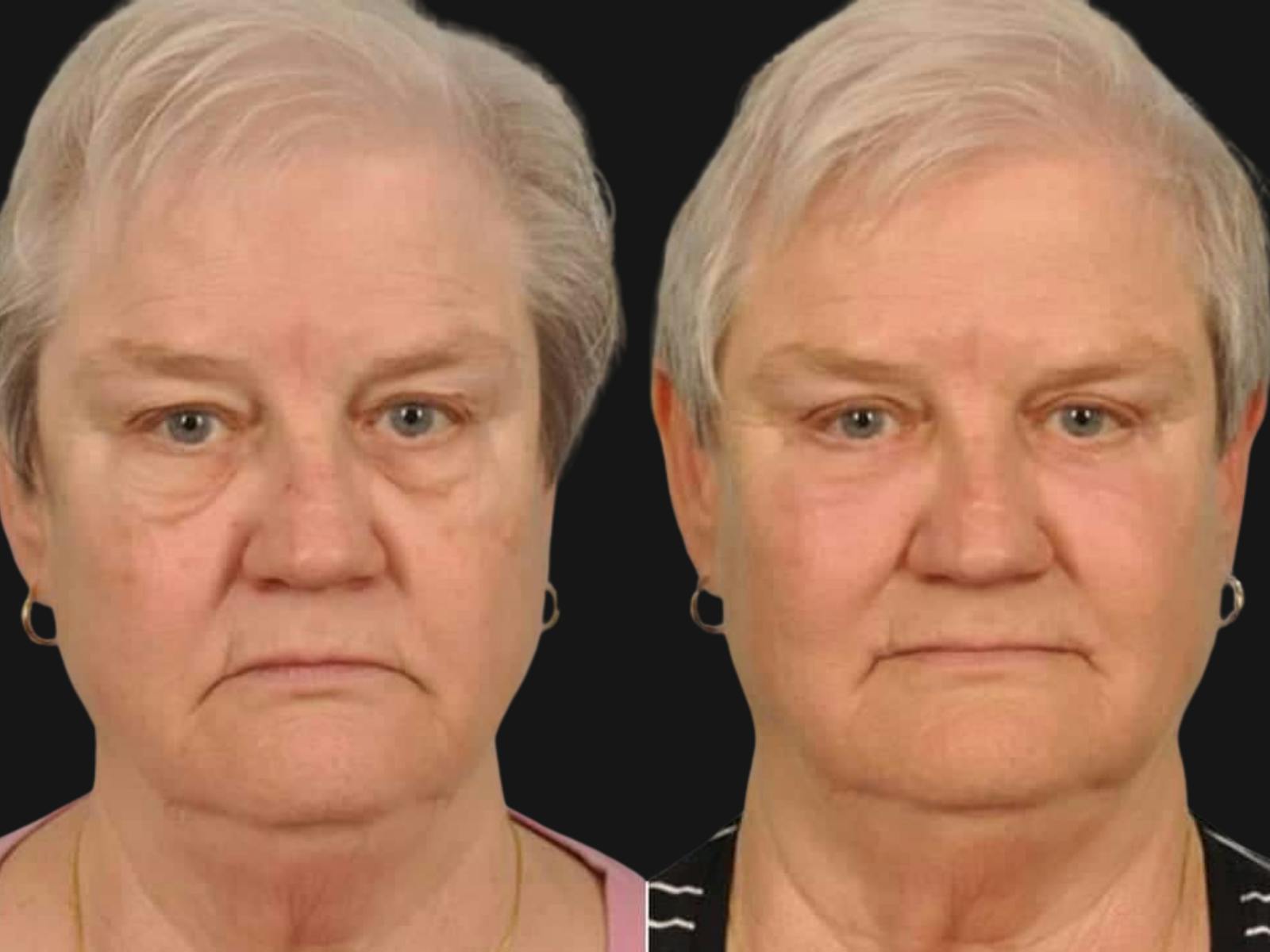 Blepharoplasty Before & After Gallery - Patient 246192 - Image 1
