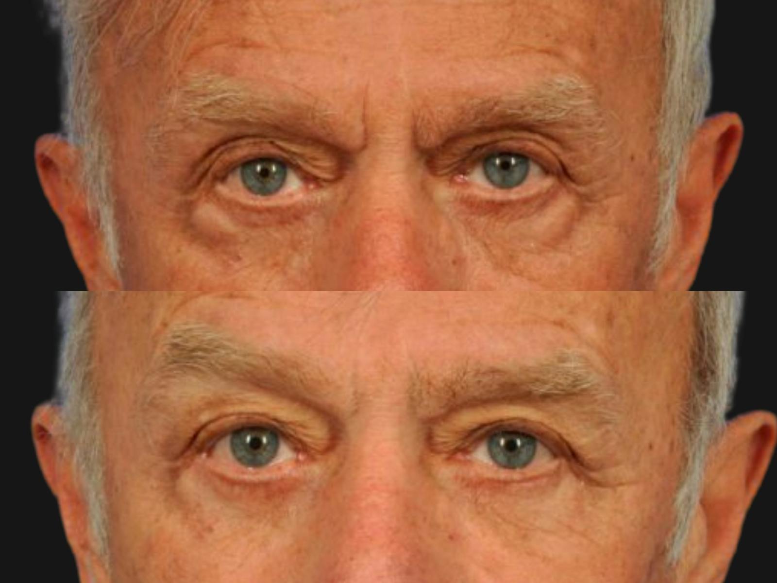 Blepharoplasty Before & After Gallery - Patient 127869 - Image 2