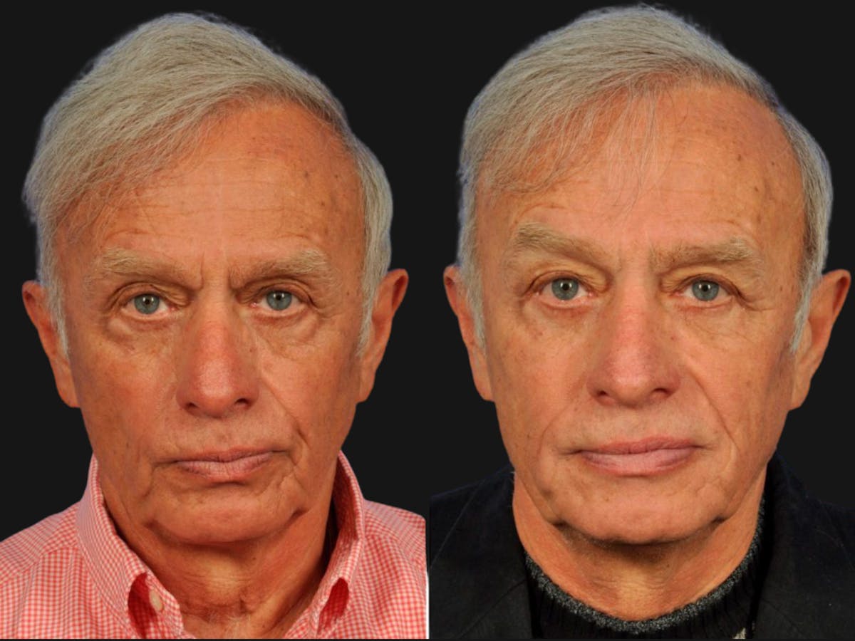 Blepharoplasty Before & After Gallery - Patient 127869 - Image 1