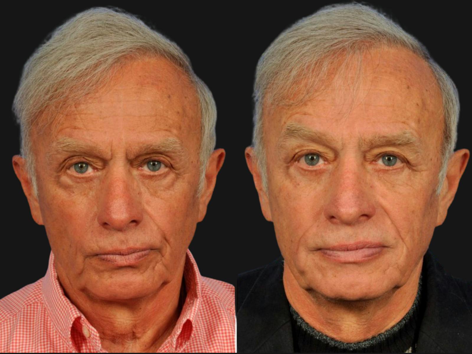 Blepharoplasty Before & After Gallery - Patient 127869 - Image 1