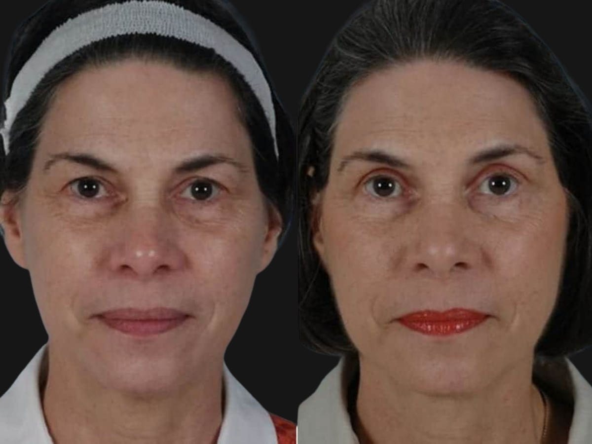Blepharoplasty Before & After Gallery - Patient 241712 - Image 1