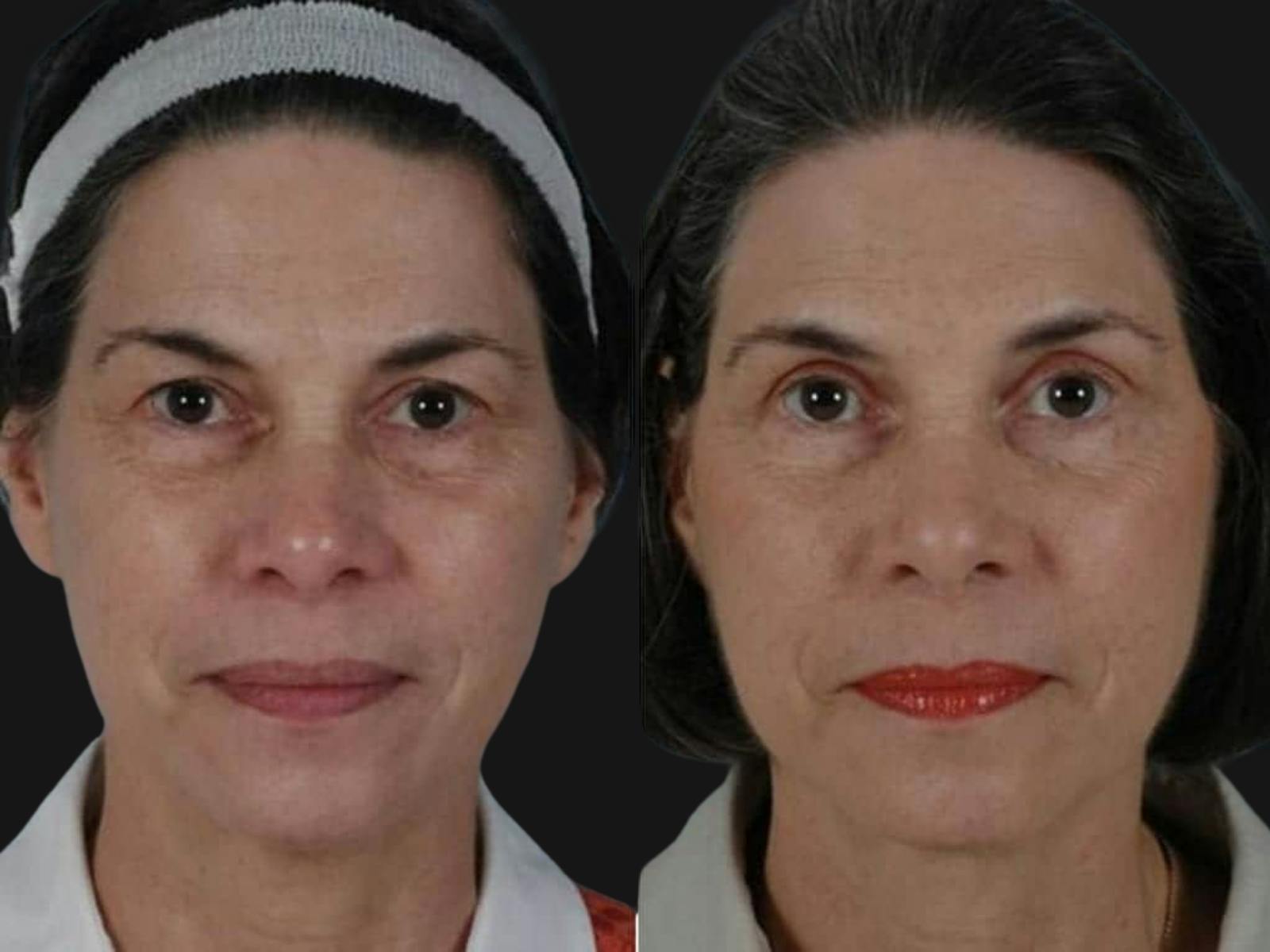 Blepharoplasty Before & After Gallery - Patient 241712 - Image 1