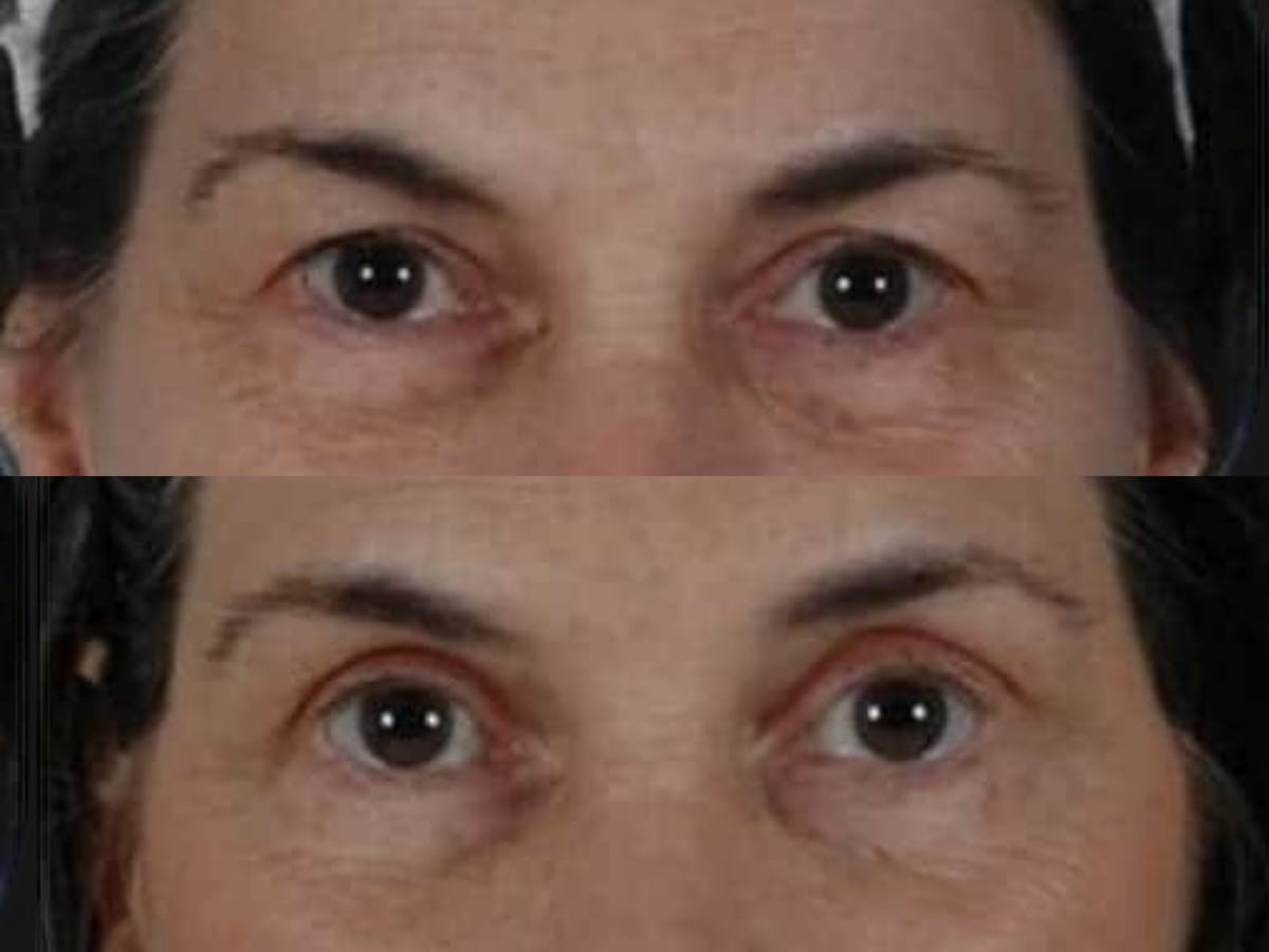 Blepharoplasty Before & After Gallery - Patient 241712 - Image 2