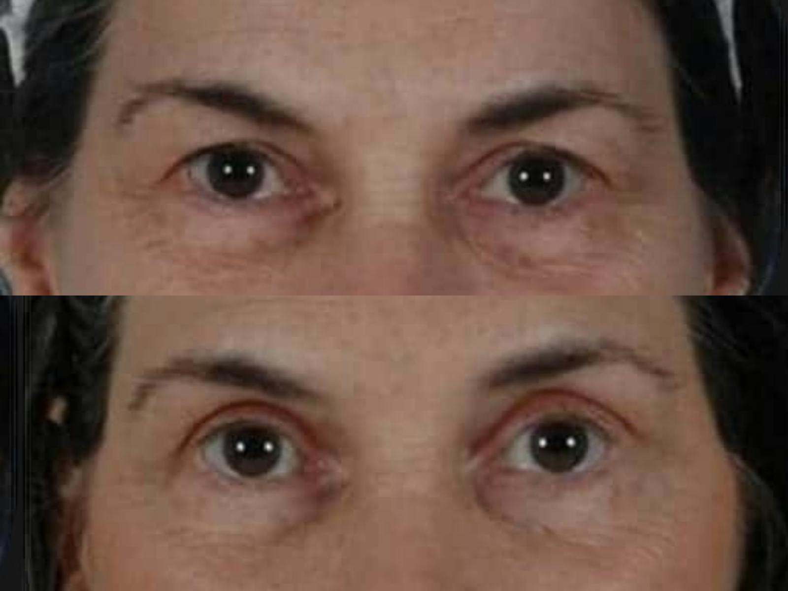 Blepharoplasty Before & After Gallery - Patient 241712 - Image 2