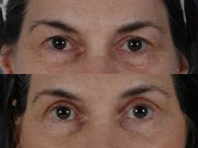 Blepharoplasty Before & After Gallery - Patient 241712 - Image 2