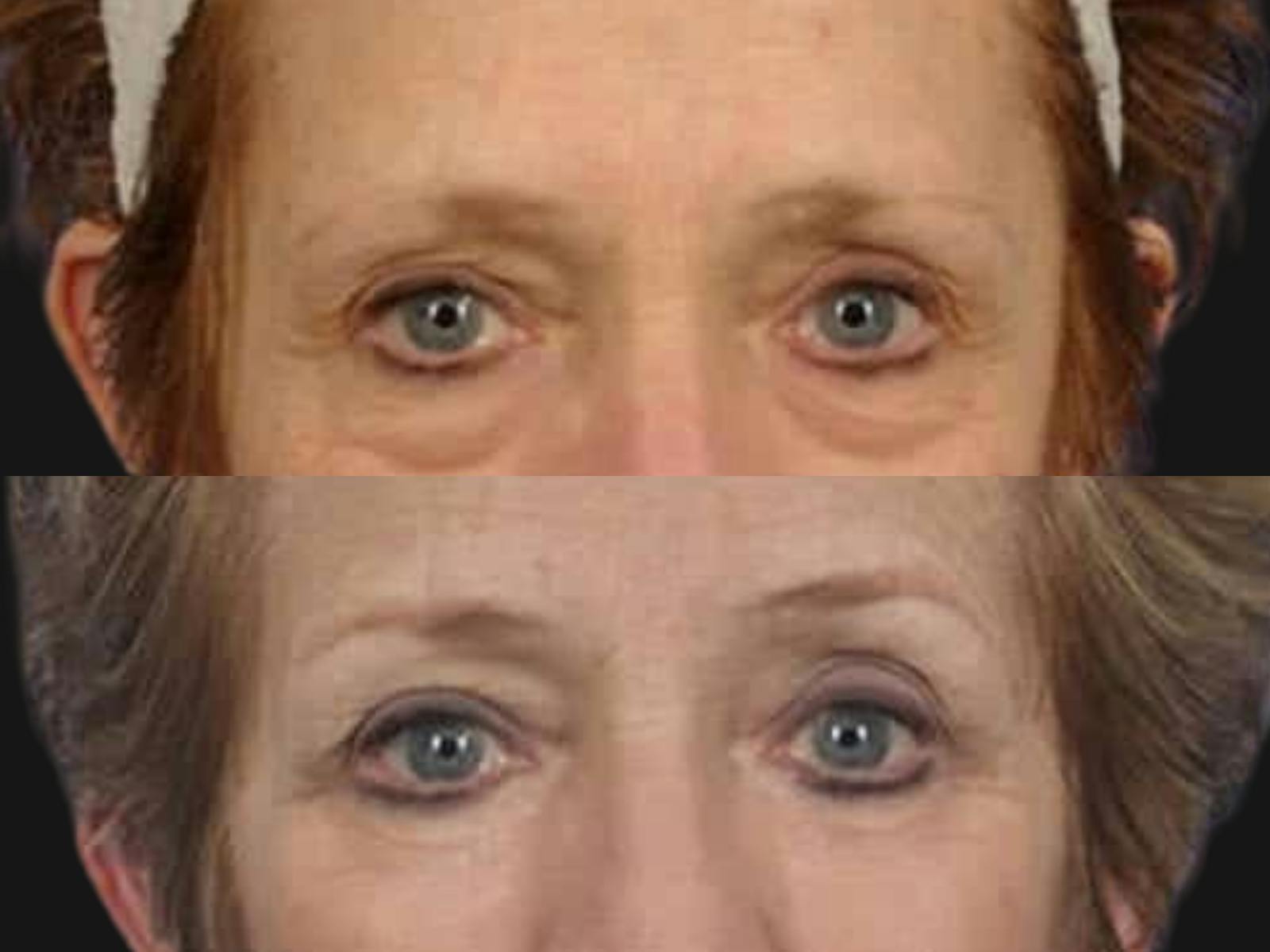 Blepharoplasty Before & After Gallery - Patient 352730 - Image 2