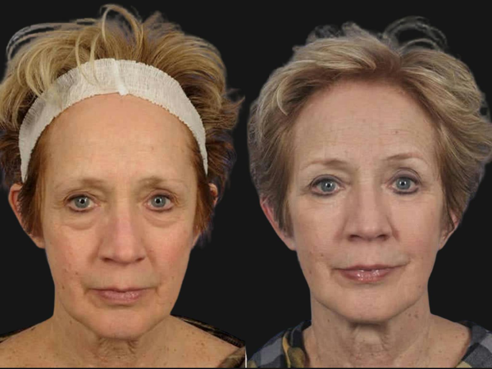 Blepharoplasty Before & After Gallery - Patient 352730 - Image 1