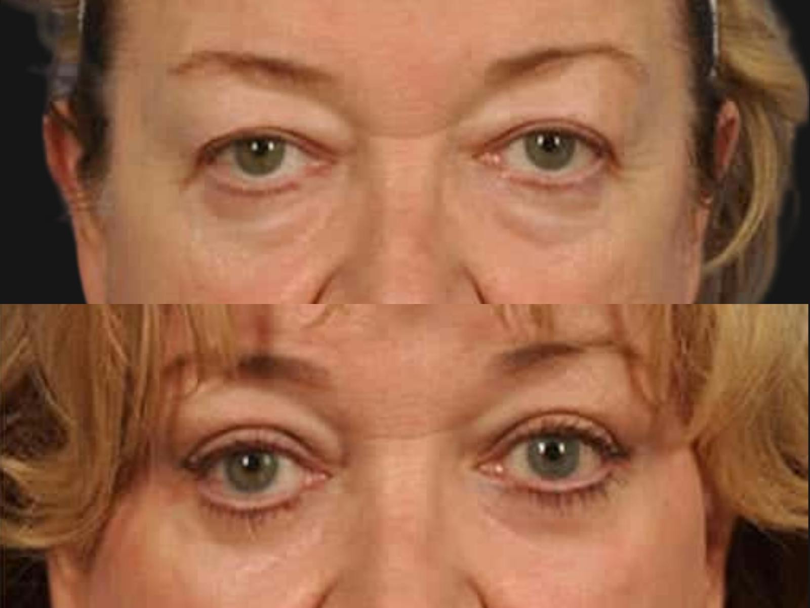 Blepharoplasty Before & After Gallery - Patient 397958 - Image 2