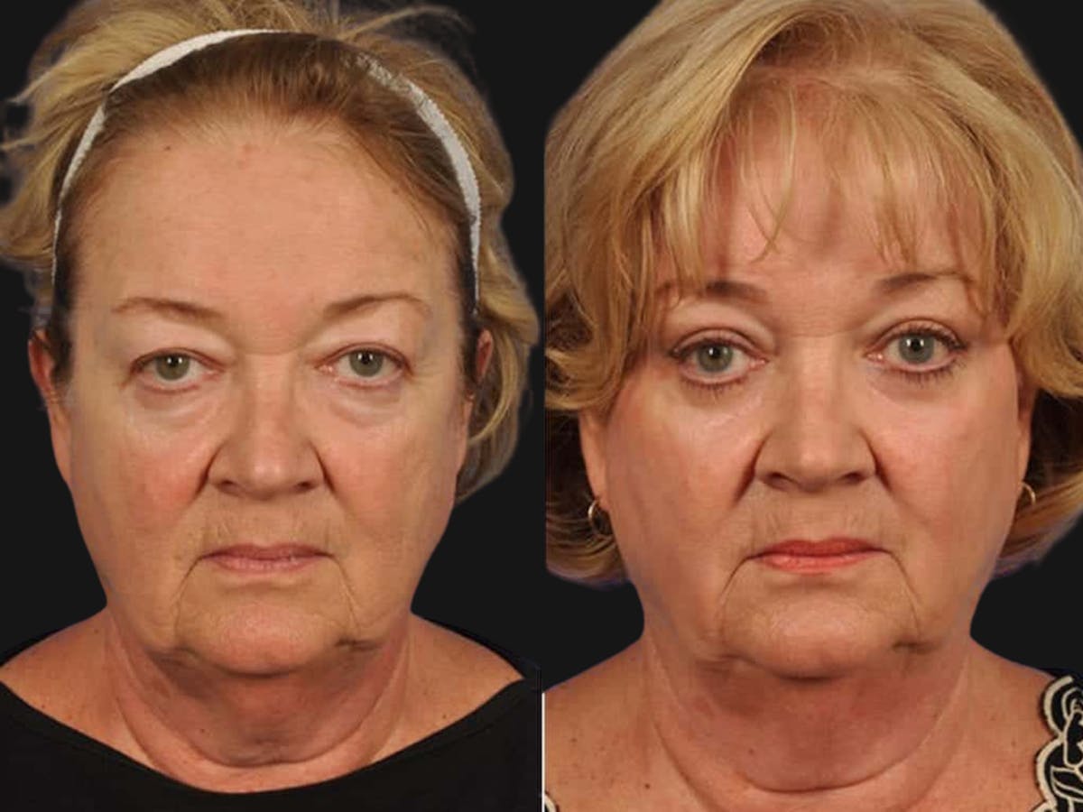 Blepharoplasty Before & After Gallery - Patient 397958 - Image 1