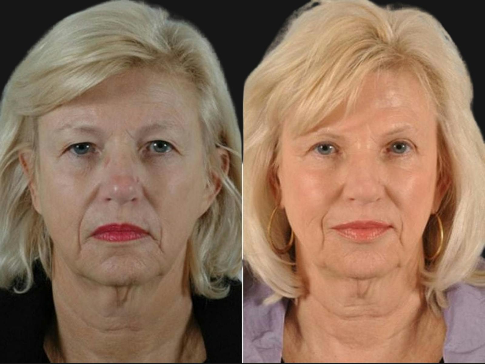 Blepharoplasty Before & After Gallery - Patient 171375 - Image 1