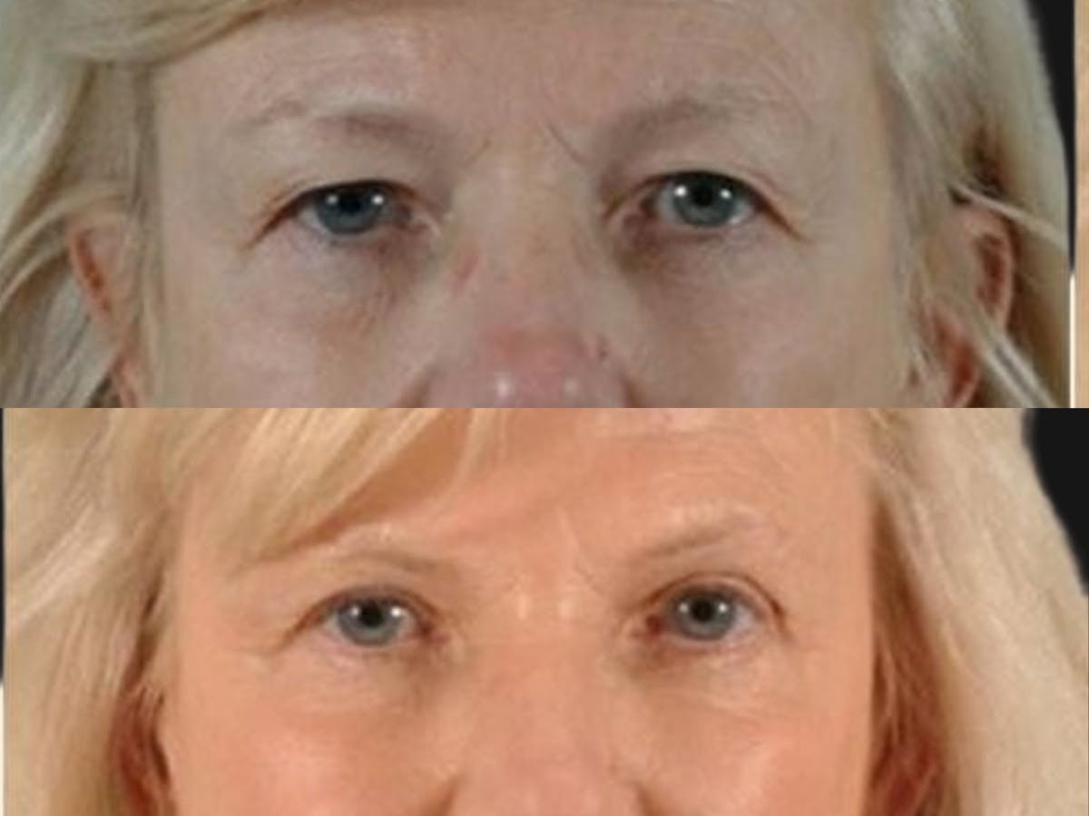 Blepharoplasty Before & After Gallery - Patient 171375 - Image 2