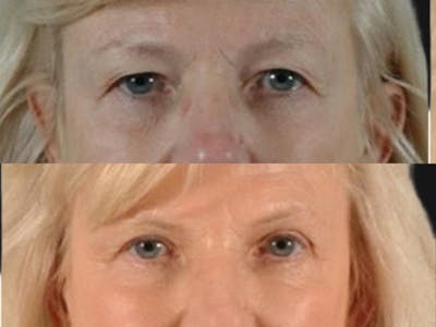 Blepharoplasty Before & After Gallery - Patient 171375 - Image 2