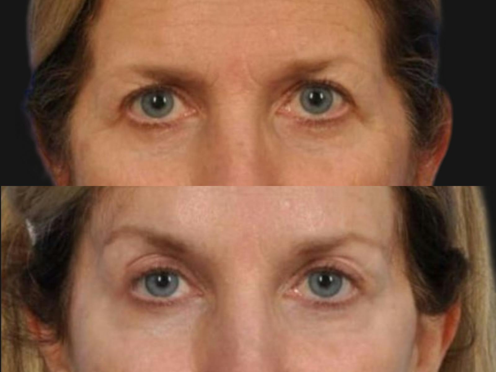 Blepharoplasty Before & After Gallery - Patient 249755 - Image 2