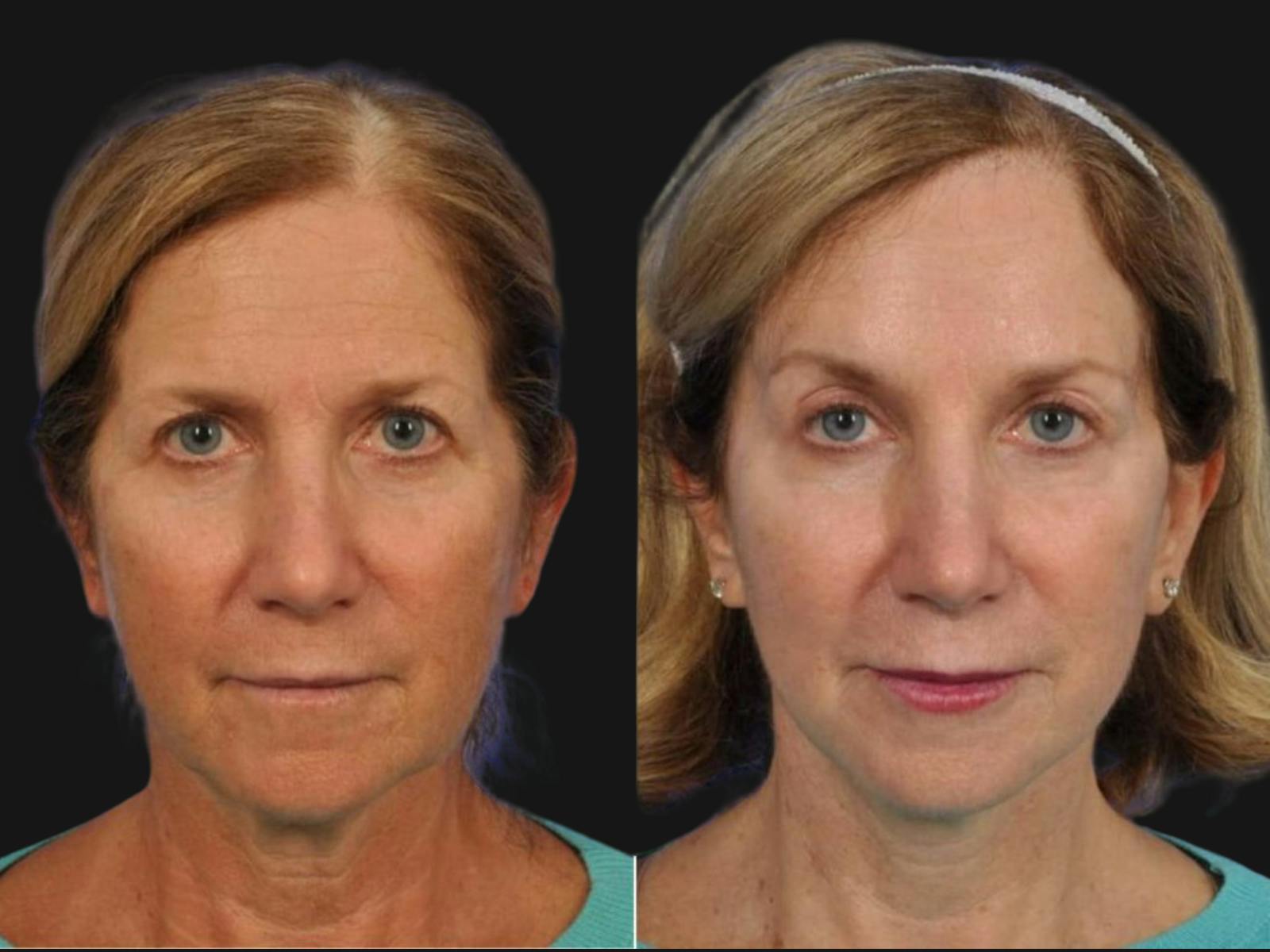 Blepharoplasty Before & After Gallery - Patient 249755 - Image 1
