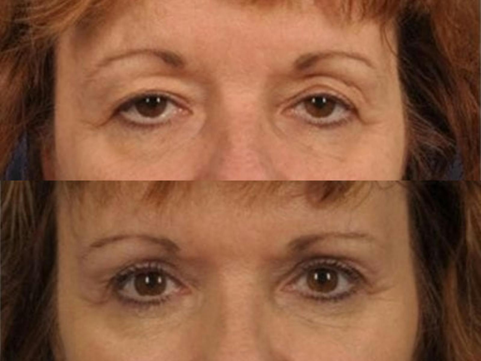 Blepharoplasty Before & After Gallery - Patient 373762 - Image 2