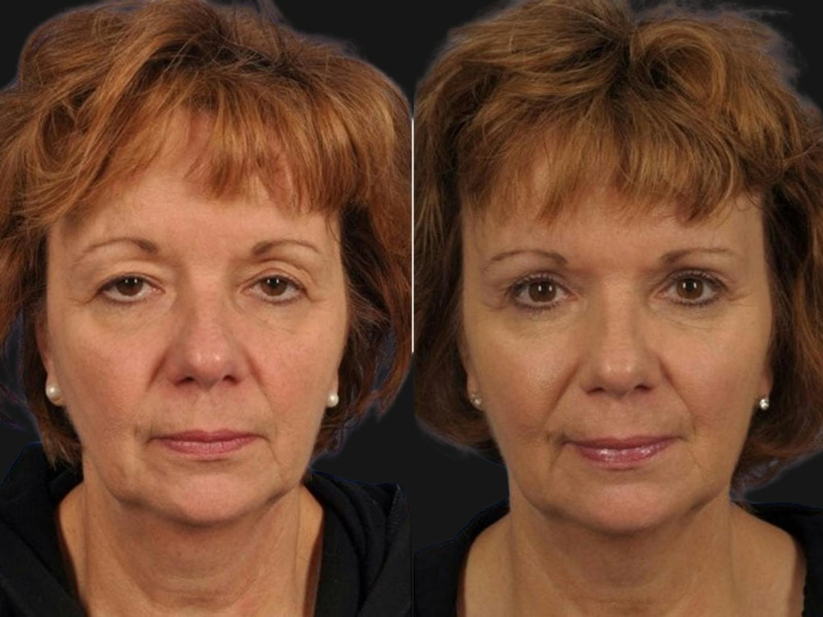 Blepharoplasty Before & After Gallery - Patient 373762 - Image 1