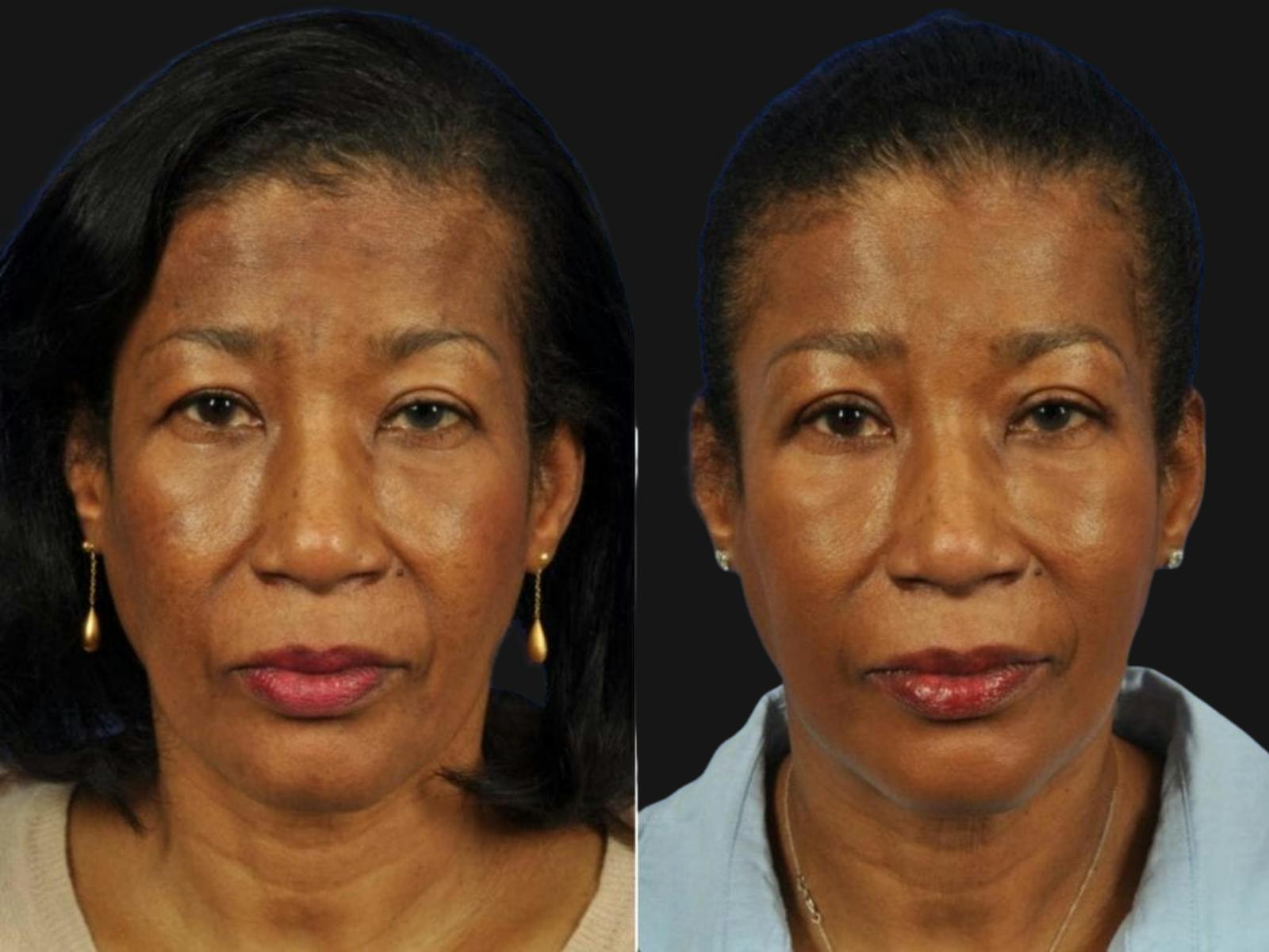 Blepharoplasty Before & After Gallery - Patient 124115 - Image 1