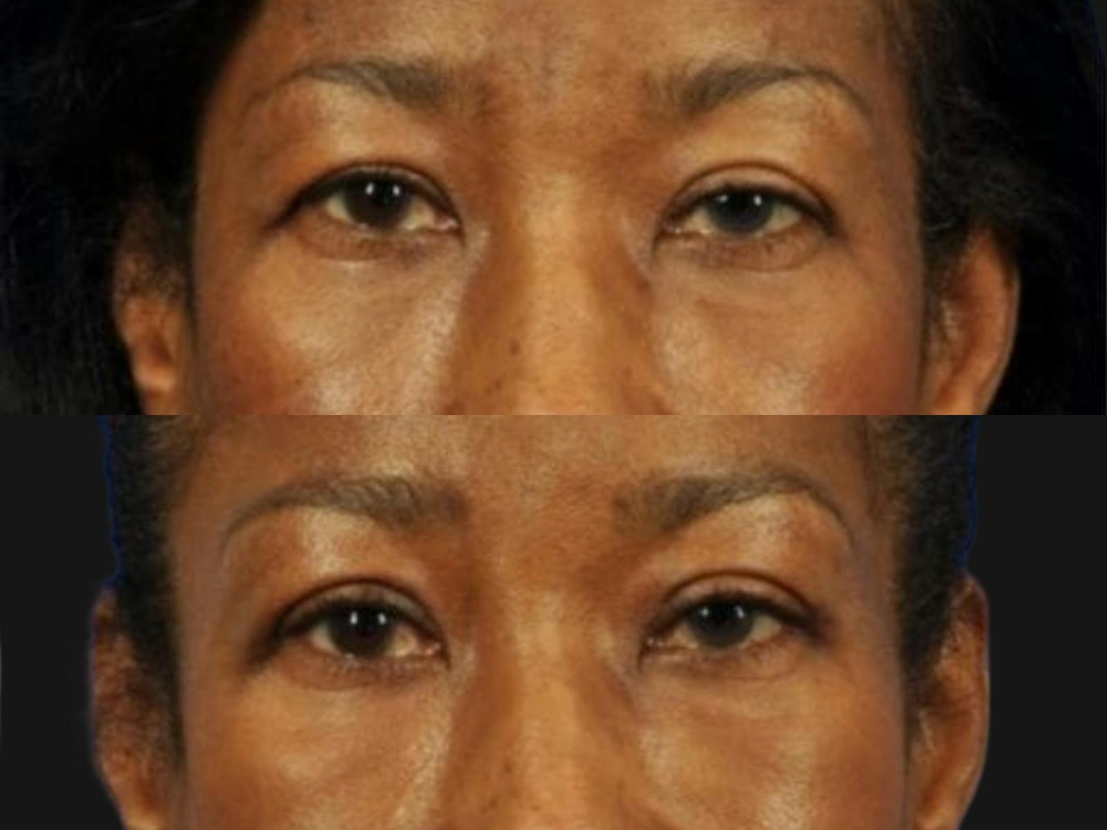 Blepharoplasty Before & After Gallery - Patient 124115 - Image 2
