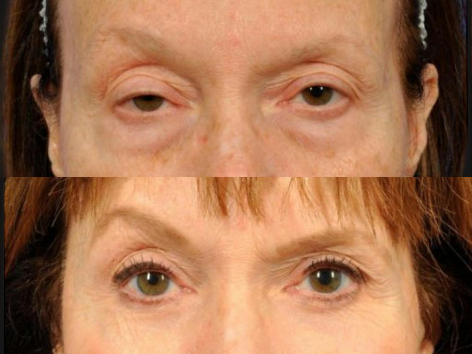 Blepharoplasty Before & After Gallery - Patient 178904 - Image 2