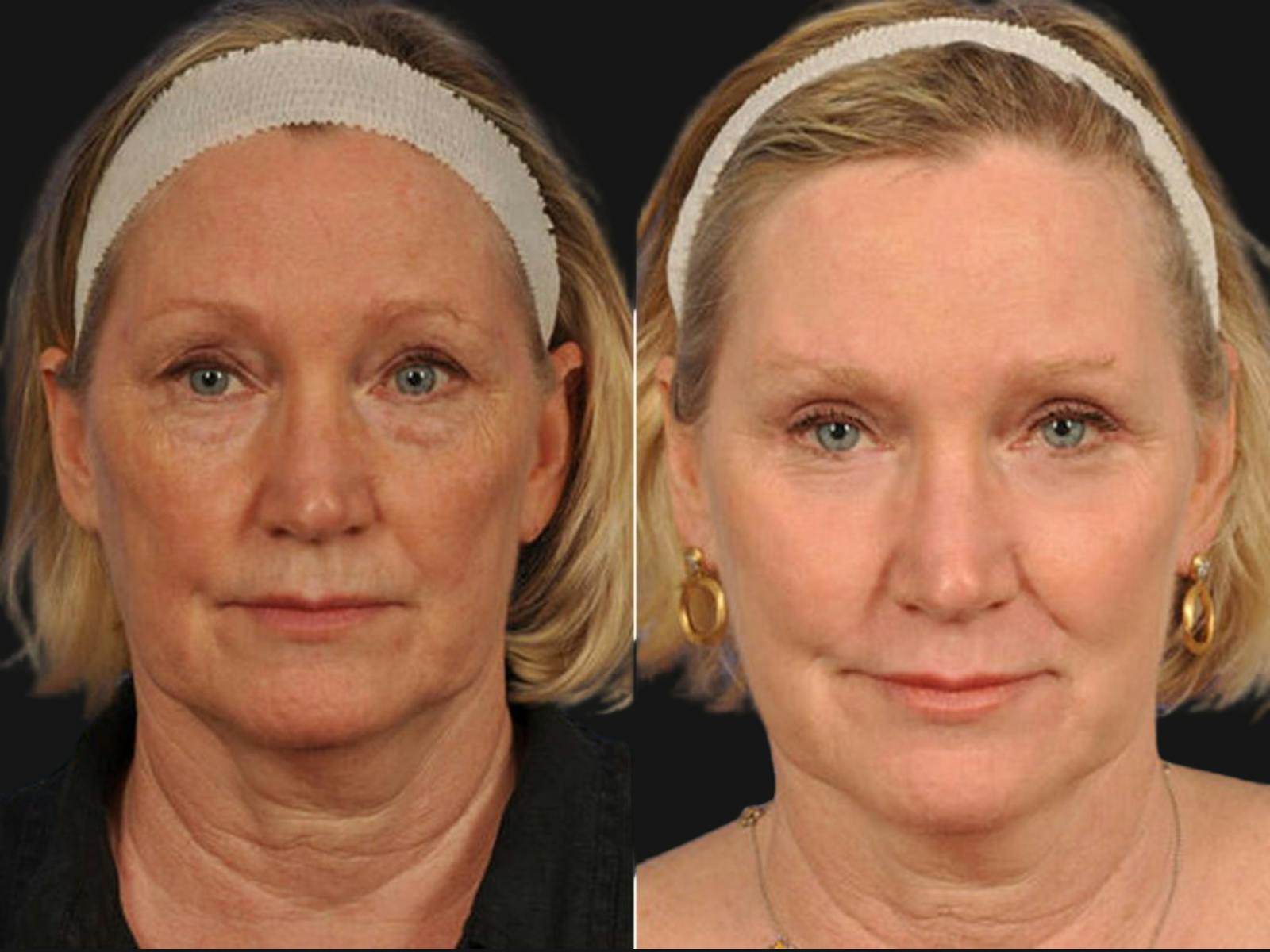 Blepharoplasty Before & After Gallery - Patient 353316 - Image 1