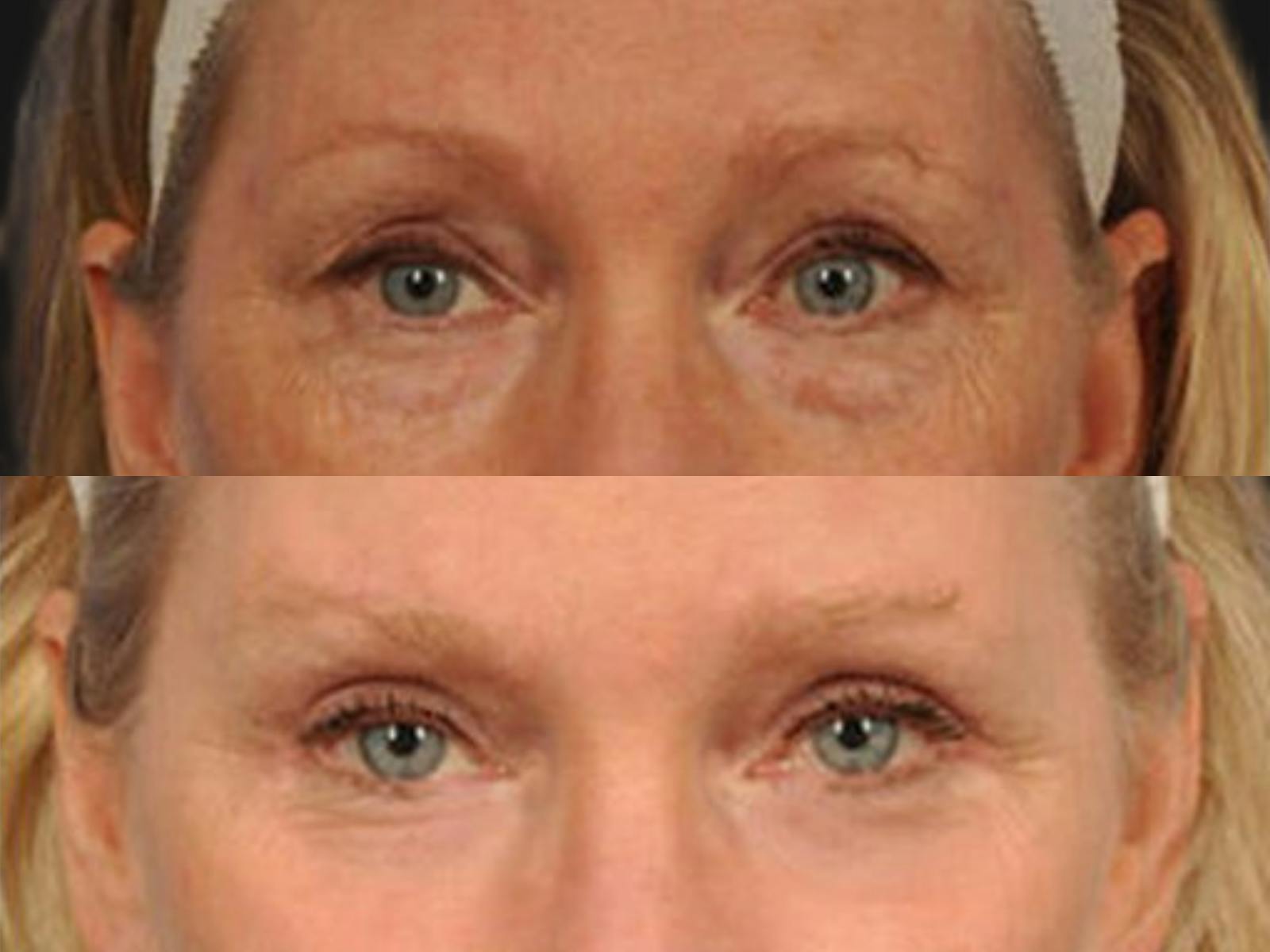 Blepharoplasty Before & After Gallery - Patient 353316 - Image 2