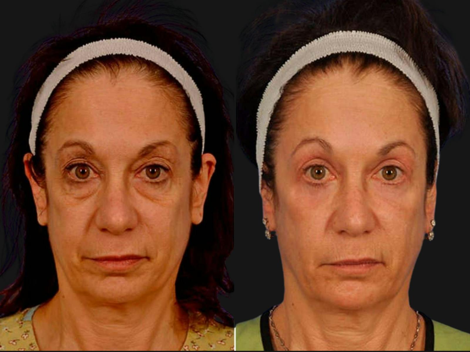 Blepharoplasty Before & After Gallery - Patient 627532 - Image 1