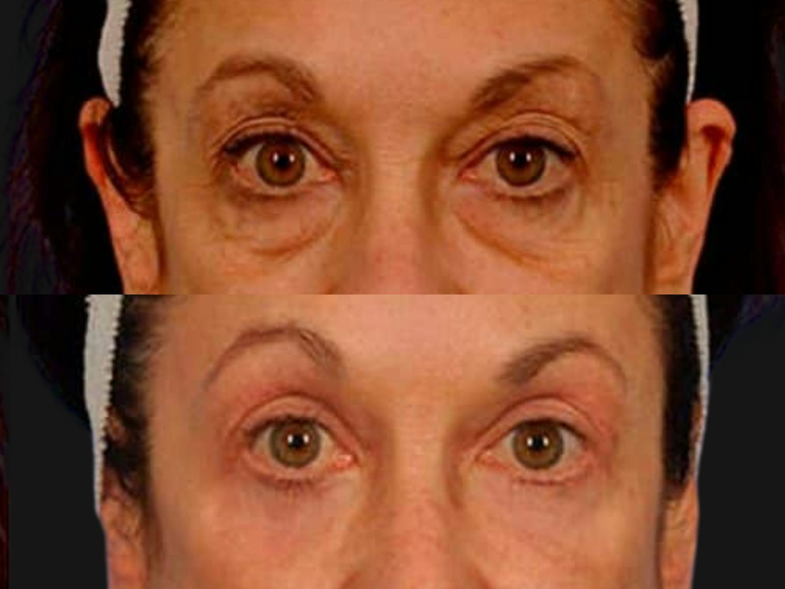 Blepharoplasty Before & After Gallery - Patient 627532 - Image 2